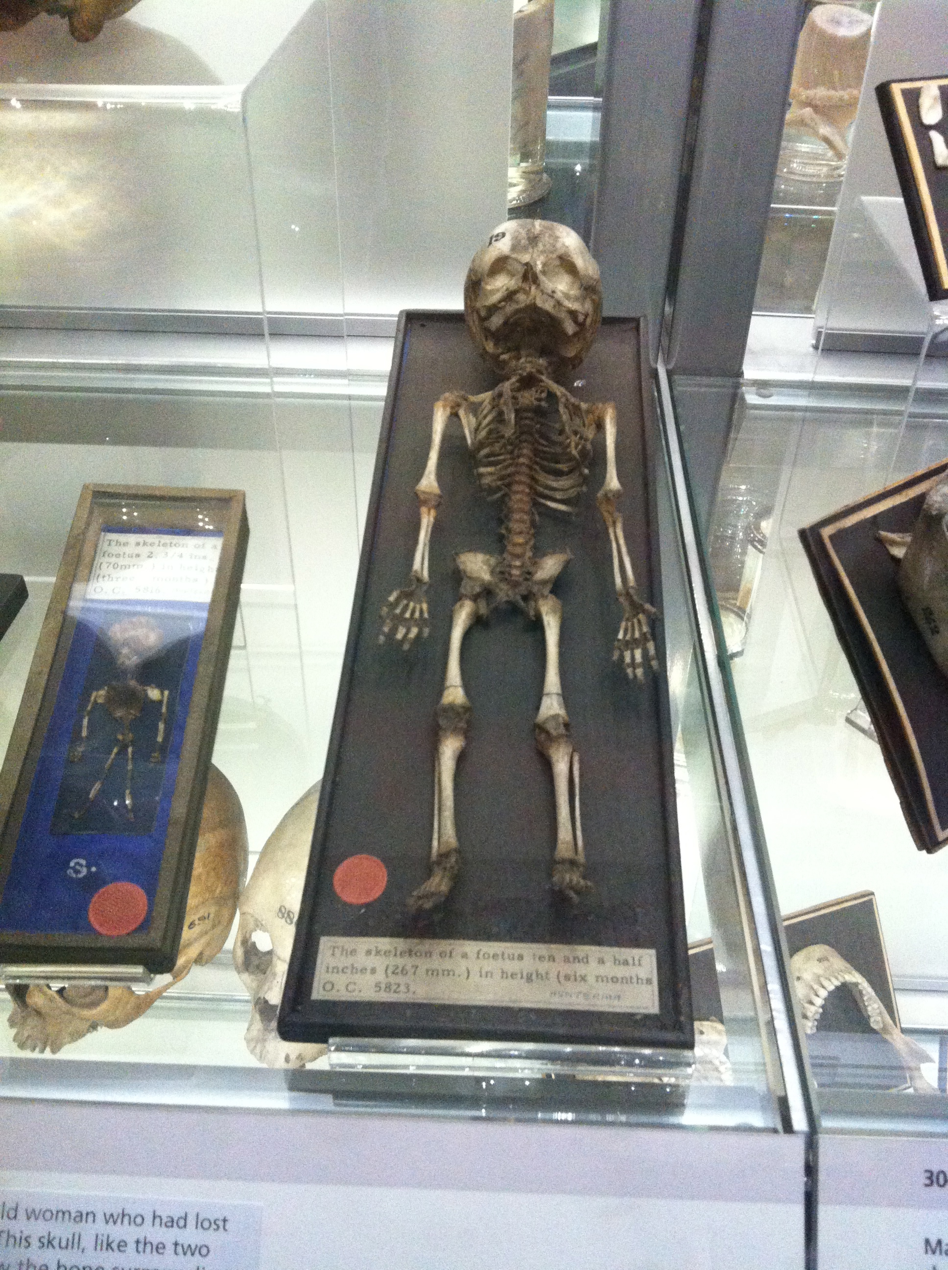 The Hunterian Museum London Foetus